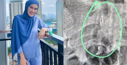 Dokter Ungkap Benda Aneh Mirip Paku di Tubuh Stevie Agnecya Ternyata Belum Bisa Dijelaskan Secara Medis, Benarkah Kena Santet?