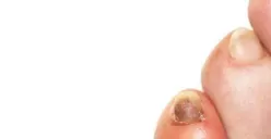 Waspada, Kadar Kolesterol dapat Terlihat dari Kuku Kaki, Pernah Cek?