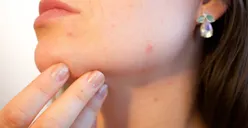 Hati-hati, Memakai Skincare Salah Bikin Wajah Kamu Dipenuhi Jerawat