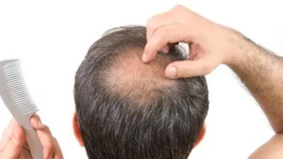 Ilustrasi rambut botak