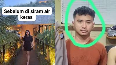 Mahasiswi Yogyakarta Jadi Korban Penyiraman Air Keras Oleh Mantan Pacar