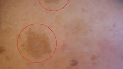Hiperpigmentasi adalah kondisi saat sebagian kulit jadi lebih gelap. Ini terjadi karena kulit memproduksi melanin terlalu banyak.