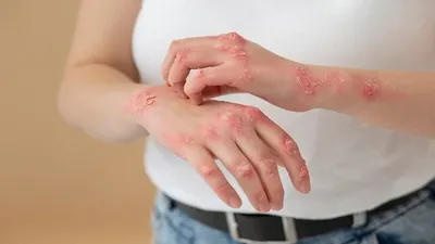 Viral! Virus Mpox Sudah Masuk ke Indonesia, Ini Dia Cara Pemerintah untuk Mencegah Lebih Banyak Lagi Cacar Monyet Masuk!
