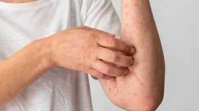 Ilustrasi Mpox atau Monkey Pox atau Cacar Monyet