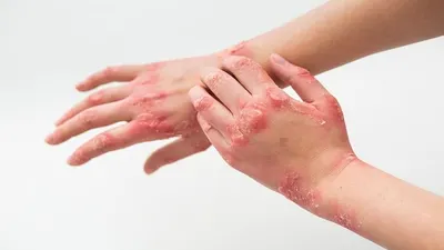 Virus Mpox atau Cacar Monyet di Indonesia