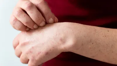 4 Cara Deteksi dan Cegah Mpox (Monkey Pox) atau Cacar Monyet, Alami Gejala Ini Langsung ke Faskes Terdekat