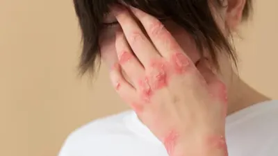 Ilustrasi. WHO resmi mengumumkan Darurat Kesehatan Global terkait Mpox.