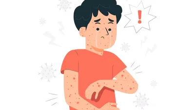 Harga vaksin Mpox dibanderol dengan harga yang mahal dibanding dengan vaksin Covid-19, benarkah hanya untuk kalangan tertentu?