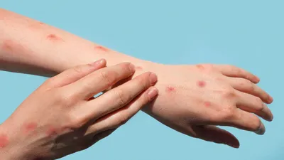Ilustrasi Mpox atau Cacar Monyet atau Mpox