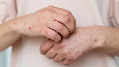 Ilustrasi Mpox atau Cacar Monyet atau Monkeypox