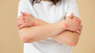 Ilustrasi virus monkeypox atau cacar monyet.