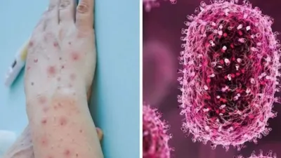 WHO Nyatakan Perang Terhadap Potensi Cacar Monyet, Ini Fakta Virus Mpox yang Perlu Diketahui!