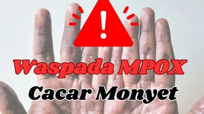 Sepanjang tahun 2023 jumlah temuan kasus Mpox di Jawa Barat diketahui tercatat sebanyak 11 pasien dan terjadi penambahan sebanyak 2 pasien pada Mei tahun 2024.
