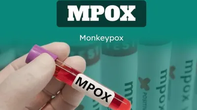 Ilustrasi. Virus Mpox
