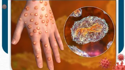 Virus Mpox