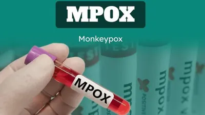 Menjadi sorotan usai ditetapkan WHO sebagai Darurat Global, potensi penyebaran virus Monkeypox atau Mpox kini menuai perhatian masyarakat.