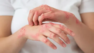 Kementerian Kesehatan (Kemenkes) mengimbau kepada masyarakat Indonesia agar tetap waspada terhadap penyebaran cacar monyet atau mpox.