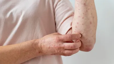 Ketua Perdoski Sebut Kasus Mpox di Indonesia Tak Semasif Pandemi Covid-19