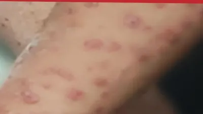 Virus Mpox atau Cacar Monyet Sudah Tersebar di Indonesia, Ternyata Sudah Masuk sejak 2022! di Mana?