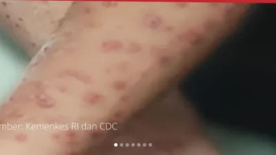 Suspek MPOX atau Cacar Monyet Ditemukan di Sumatera Barat Agustus 2024 Berdasarkan Laporan Kementerian Kesehatan, Apakah Gejalanya?