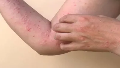 Cacar Monyet atau Monkey Pox