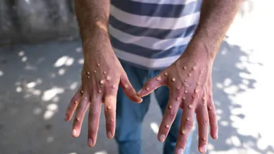 Untuk mengurangi dampak penyebaran virus Mpox ini adalah dengan mengetahui bagaimana cara penularan virus Mpox dari manusia ke manusia.