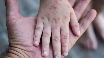 Ilustrasi Mpox atau Monkeypox atau Cacar Monyet