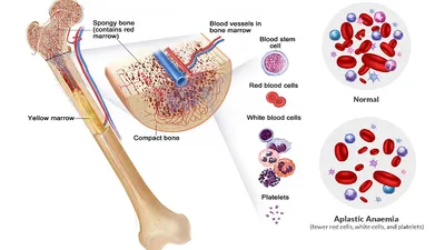 Mengenal Penyakit Anemia Aplastik yang Diderita Almarhum Babe Cabita