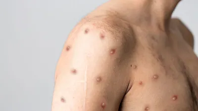 4 Kondisi yang Bisa Membuat Seseorang Terkena Virus Mpox, Cara Penyebaran Ada yang Mirip Covid 19