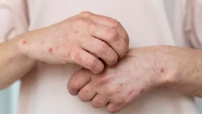 BAHAYA! Hati-hati Marak Penyakit Scabies. Ini Gejala, Penyebab, dan Cara Mengobatinya