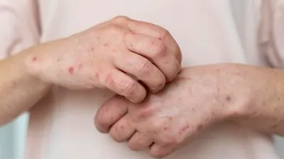BEDA! 88 Kasus Mpox Telah Ditemukan di Indonesia, Ini Perbedaan Cacar Monyet dan Cacar Air Biasa