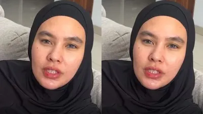 Potret Kartika Putri sedang mengalami sakit wajah dan lidah yang melepuh.