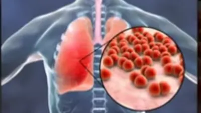 Kasus Pneumonia Akut Menyerang Tiongkok dan Belanda, Ahli Epidemiologi Paparkan Sejumlah Cara Pencegahan
