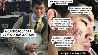 Viral Kisah Mahasiswa UGM Drop Out Gegara Jerawat, Endingnya Bikin Warganet Takjub