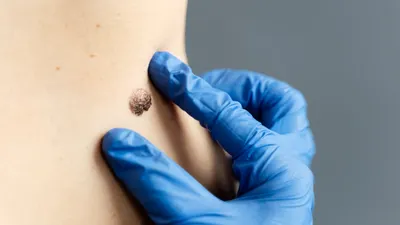 Ilustrasi cara menghilangkan kutil dengan obat alami.