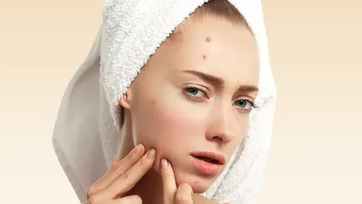 5 Tips Ampuh Mengatasi Jerawat Membandel yang Bikin Kurang Pede (Freepik)