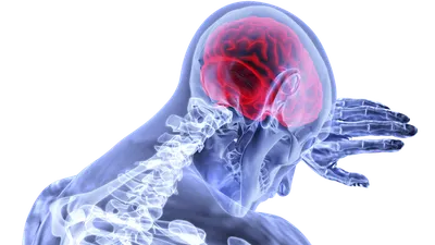 Gejala Stroke