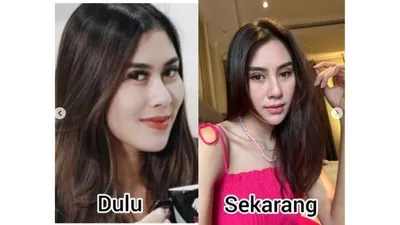 Syahnaz Sadiqah, adik dari Raffi Ahmad menjadi sorotan netizen. Dirinya dinilai melakukan operasi plastik karena berbeda dengan kondisi wajah sebelumnya.