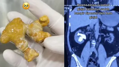 karena Kebiasaan Buruk, Ginjal Wanita Ini Dipenuhi Batu Ginjal hingga Harus Operasi