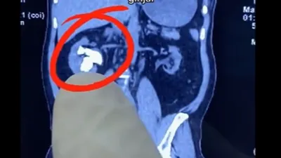 Ngeri! Mengeluh Nyeri Pinggang Lebih dari 2 Tahun, Ternyata Wanita Ini Punya Penyakit Serius