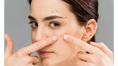 Tips Hilangkan Bekas Jerawat dan Flek Hitam di Wajah dengan 5 Bahan Alami Ini, Nomor 3 Sering Ada di Dapur