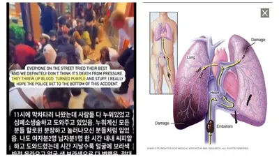beredar postingan korban pada tragedi Itaewon mengalami muntah dara menjadi 'ungu'.
