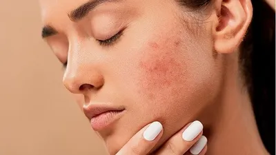 Tips Memilih Skincare yang Cocok Untuk Kulit Berminyak dan Mencegah Jerawat/pixabay
