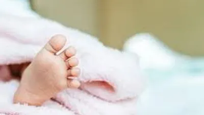 Bayi di Ciomas Bogor menderita penyakit langka
