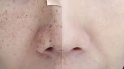 cara menghilangkan bintik hitam di wajah