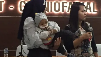 Waktu Terbaik Mendeteksi Kelainan Bibir Sumbing