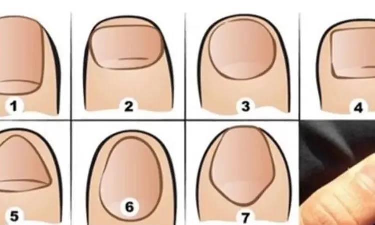 Ini dia 7 kepribadian berdasarkan bentuk kuku jempol. Kira-kira apakah kuku jempolmu cocok dengan kepribadianmu?
